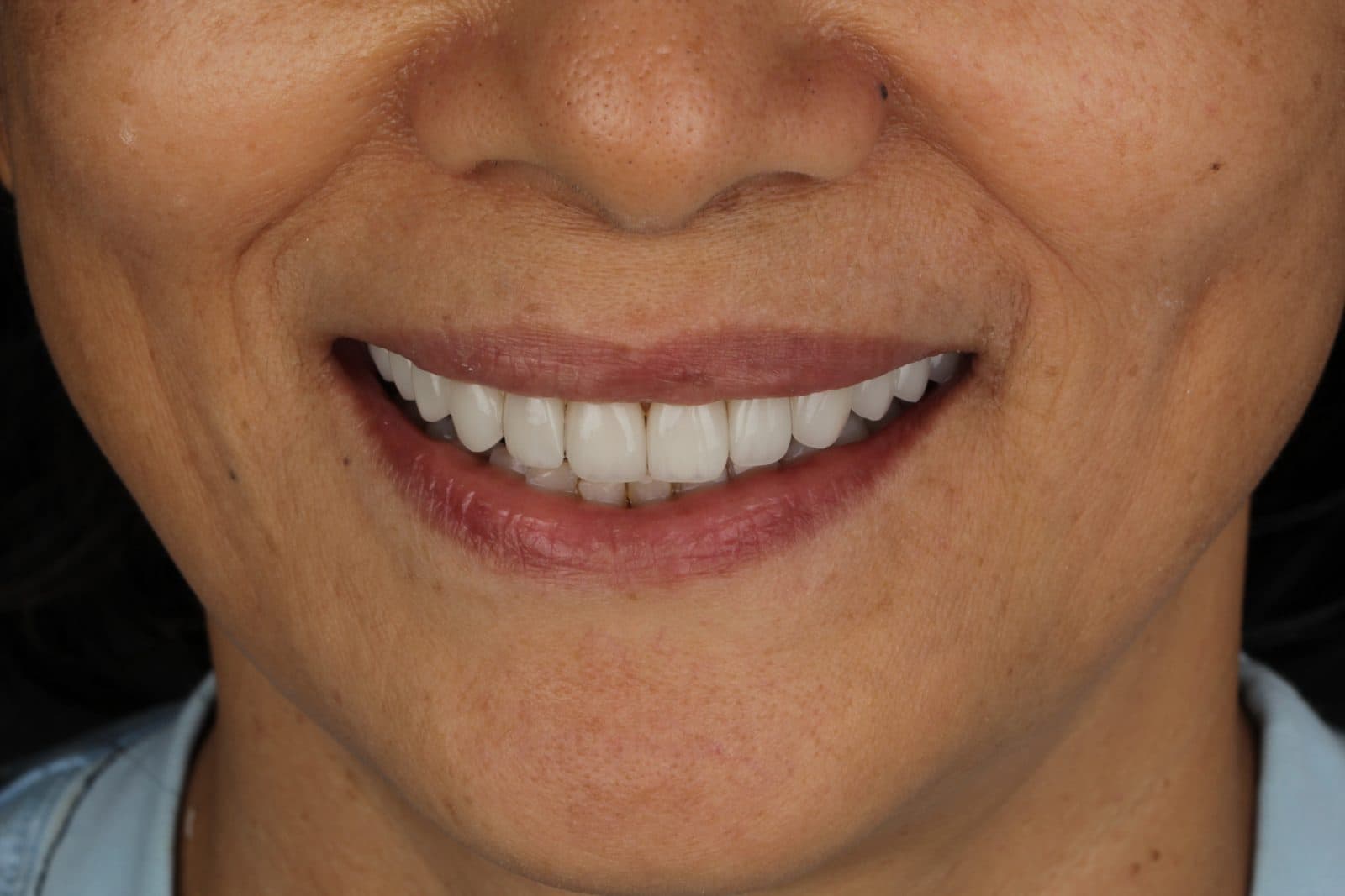 Mặt dán sứ Veneer: phục hồi men răng mòn, giữ tối đa răng thật.