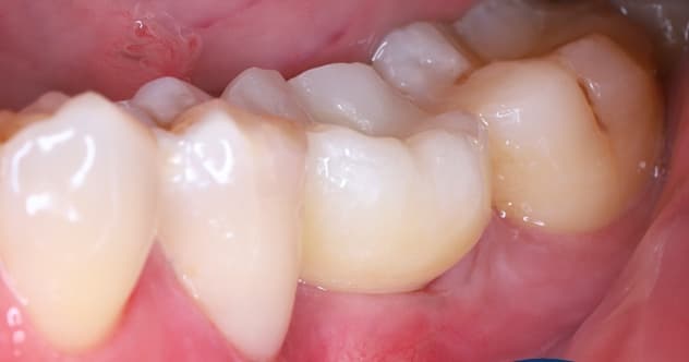 Phục hồi 1 răng mất