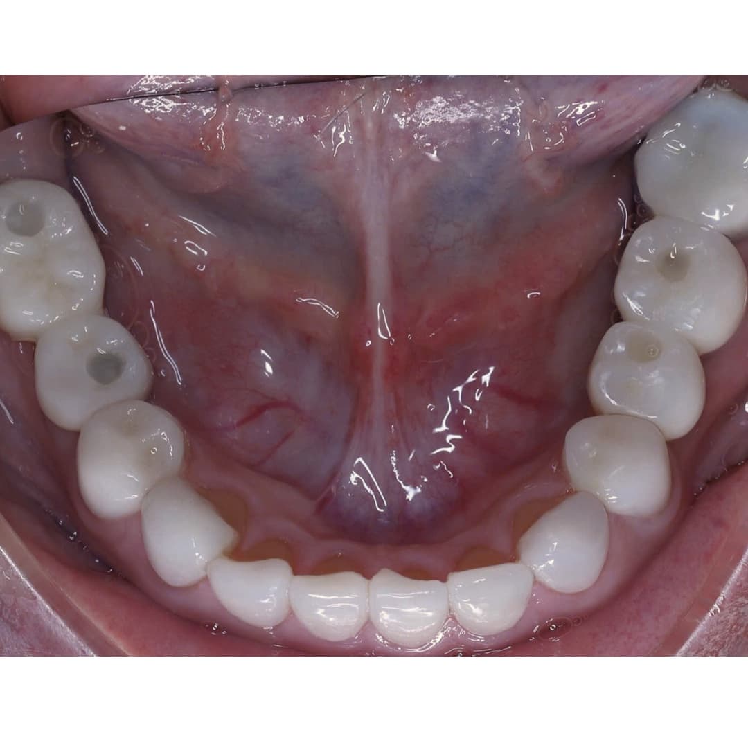 Implant nhiều răng