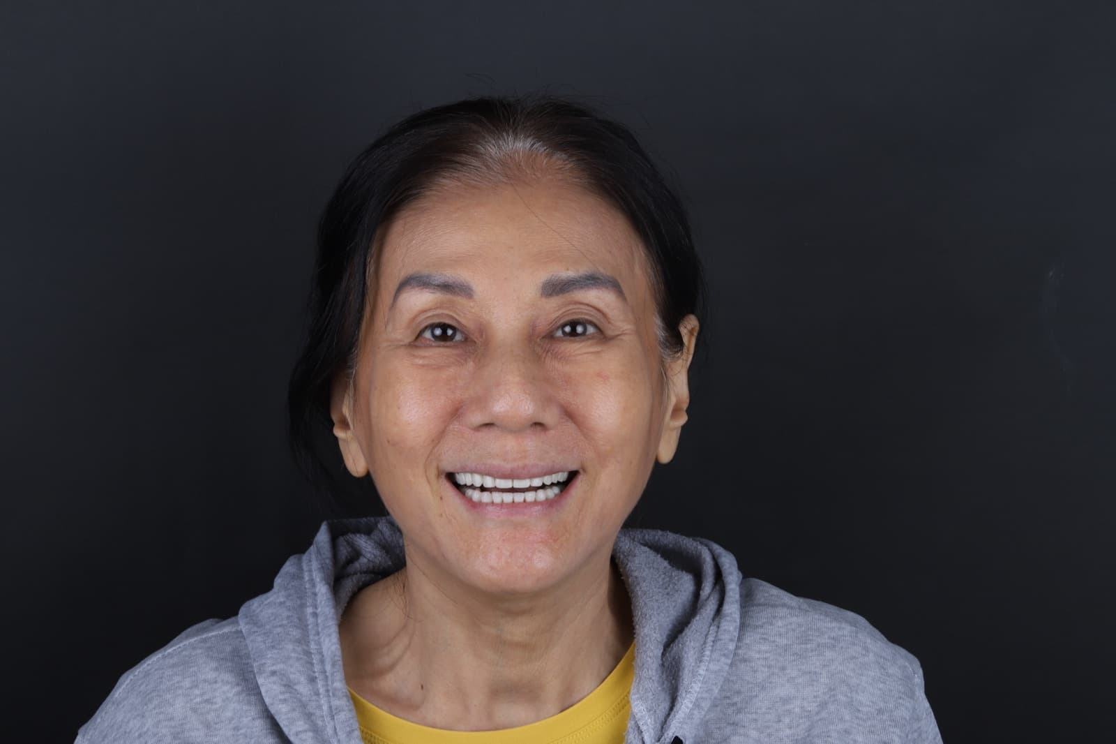 Phục hình toàn hàm trên Implant
