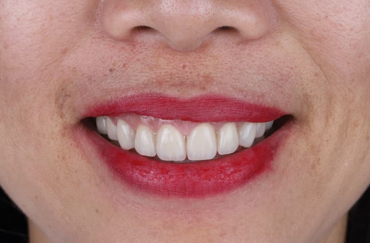Điều trị cười hở lợi