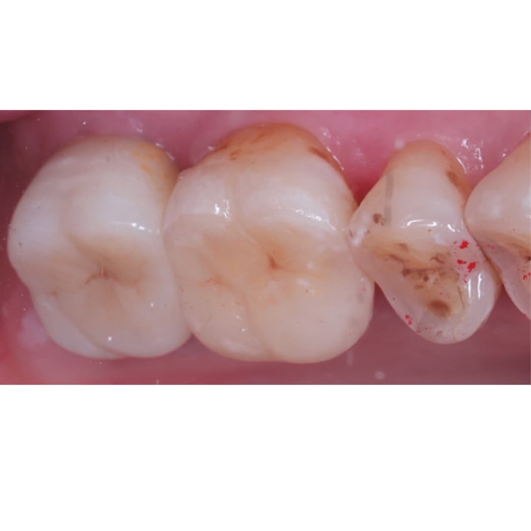 Điều trị tủy & phục hồi thân răng