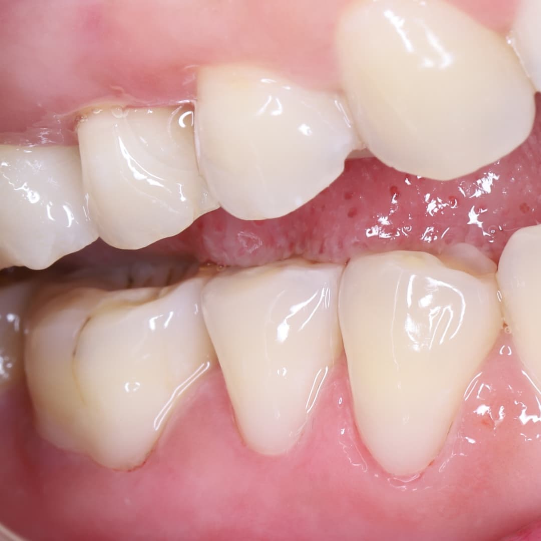 Phục hồi mòn cổ chân răng