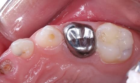 Điều trị răng sâu cho trẻ