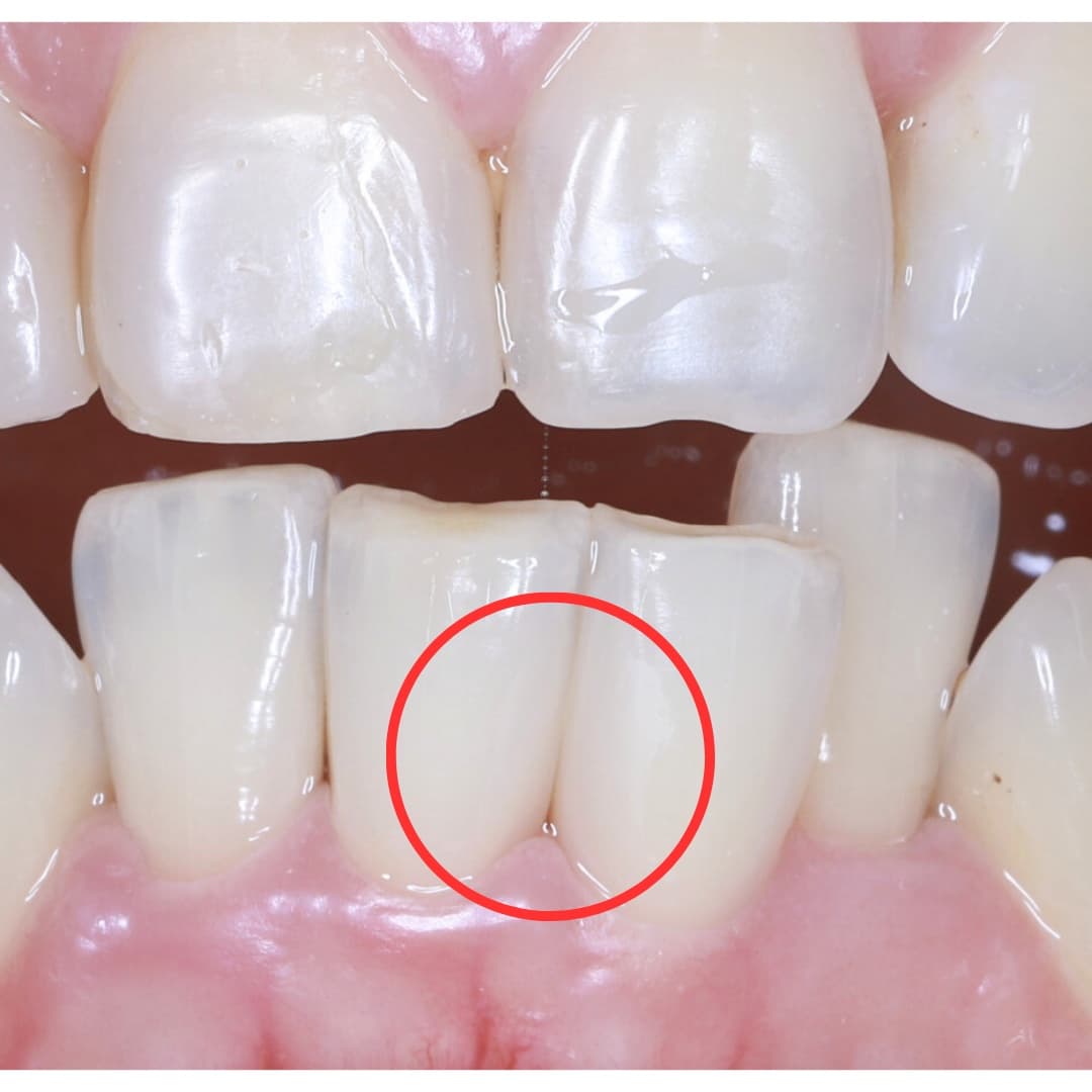 Trám răng thẩm mỹ