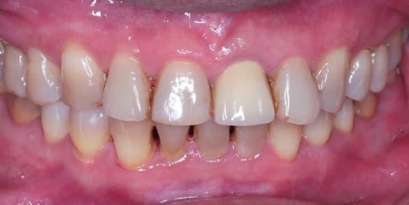 Điều trị viêm nha chu