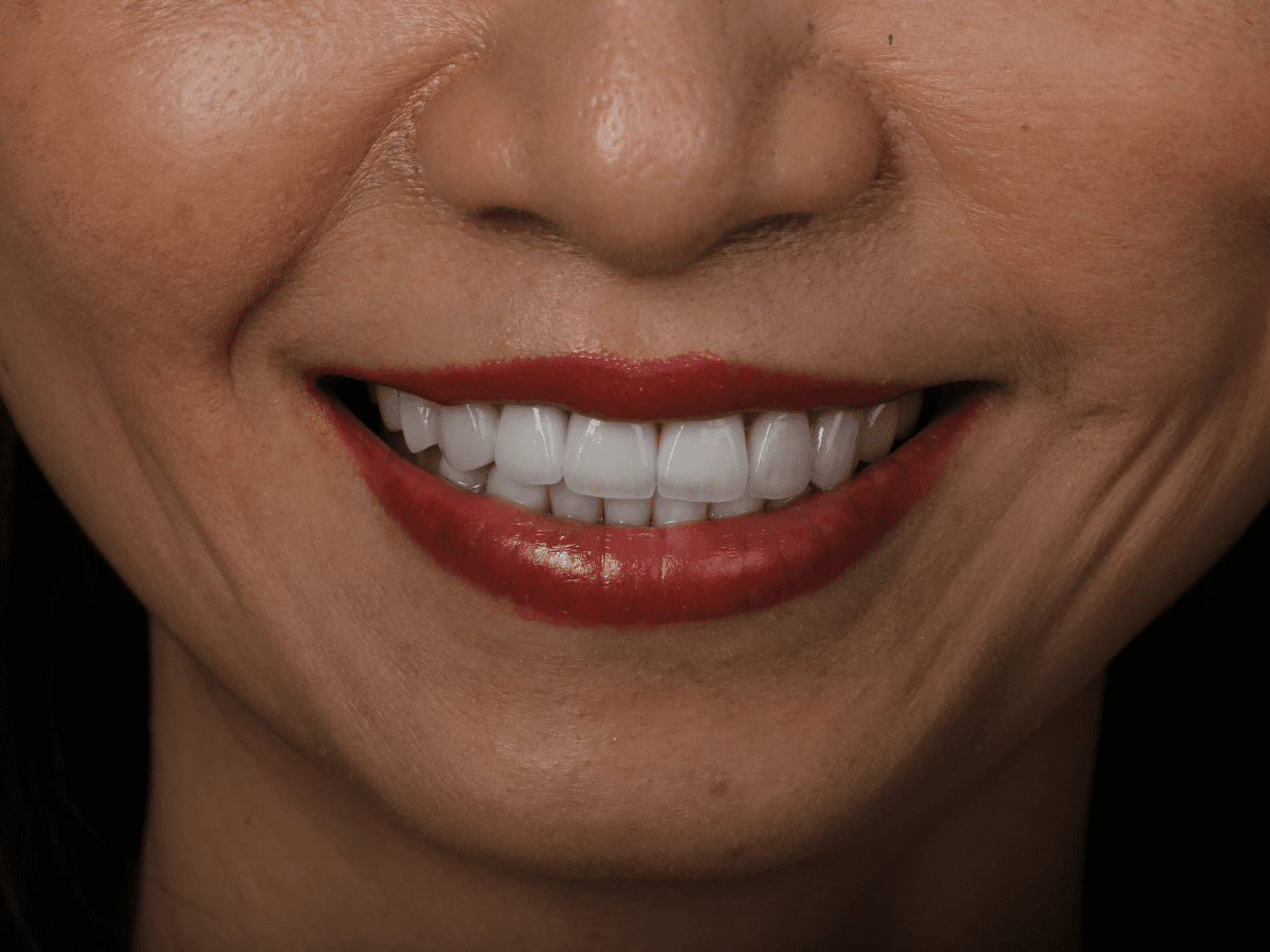Mặt dán sứ Veneer