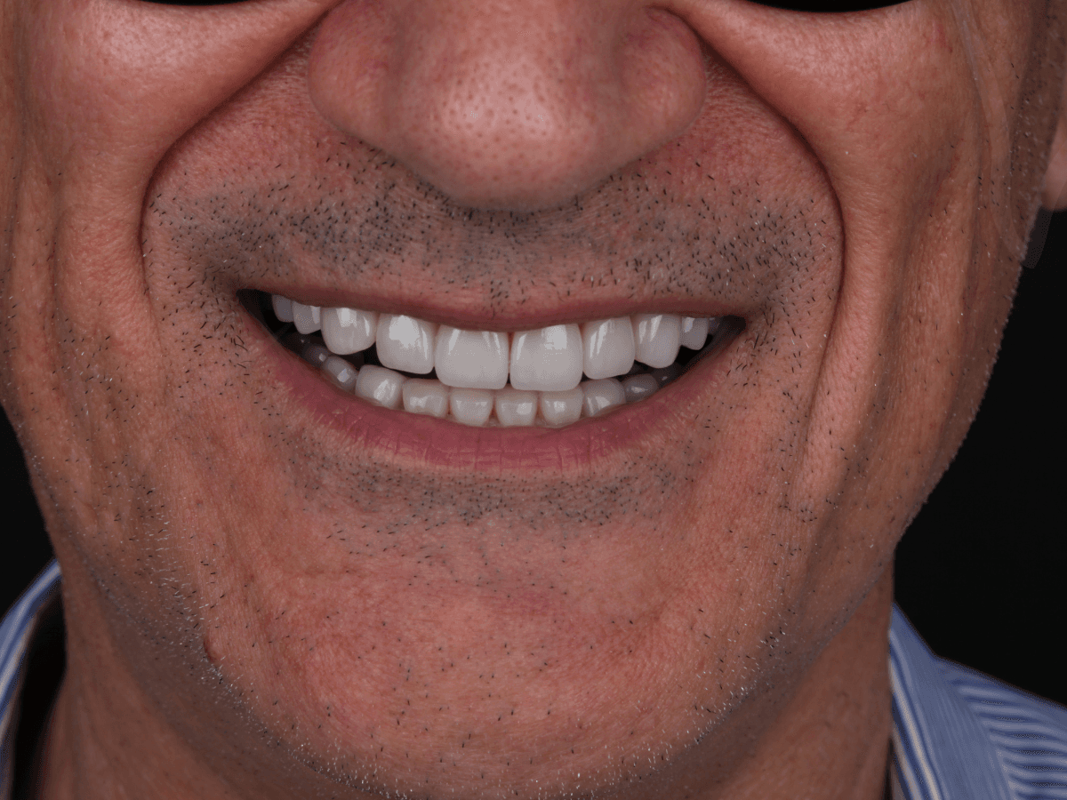 Mặt dán sứ Veneer