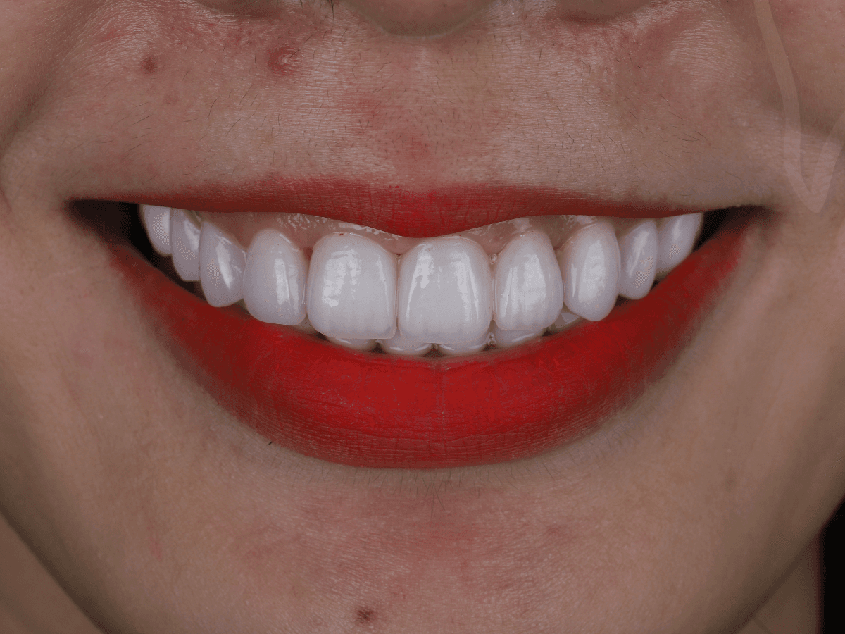 Mặt dán sứ Veneer