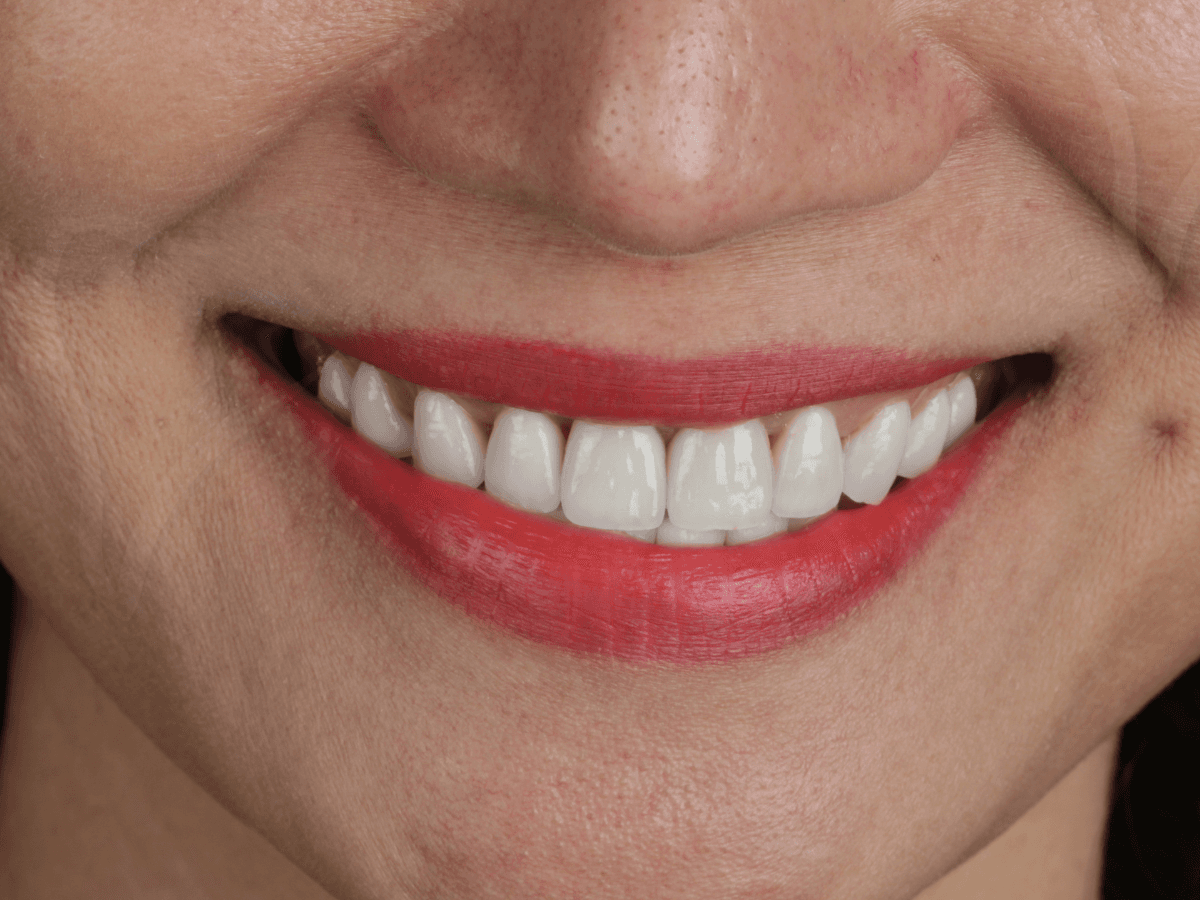Mặt dán sứ Veneer