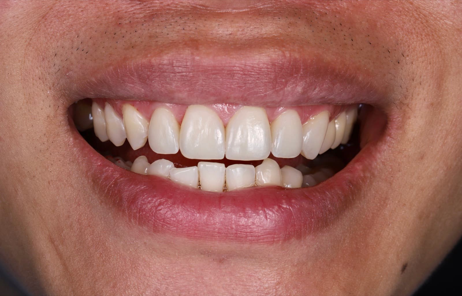 Veneer Composite – 2 răng cửa