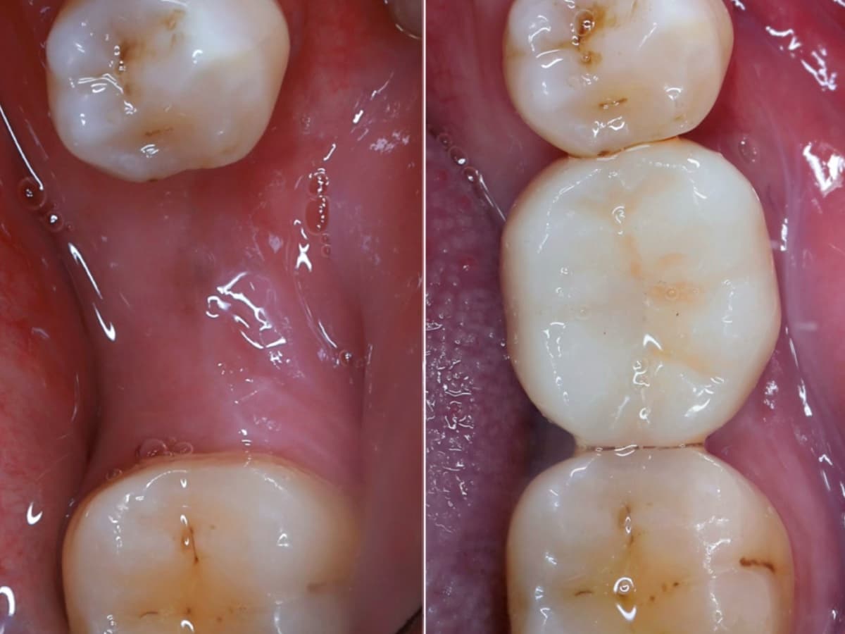 Trồng Implant 1 răng đơn lẻ