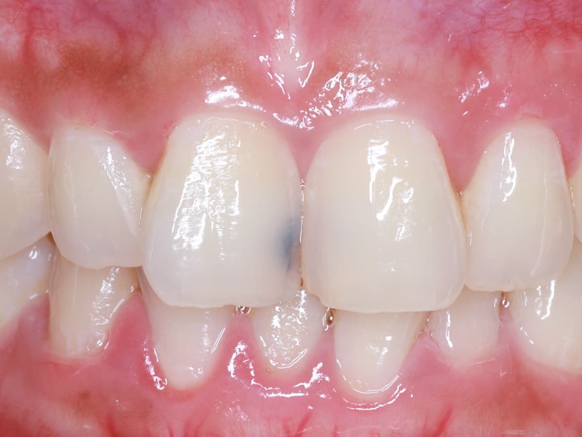 Trám răng – phục hồi răng sâu, mẻ, mòn men