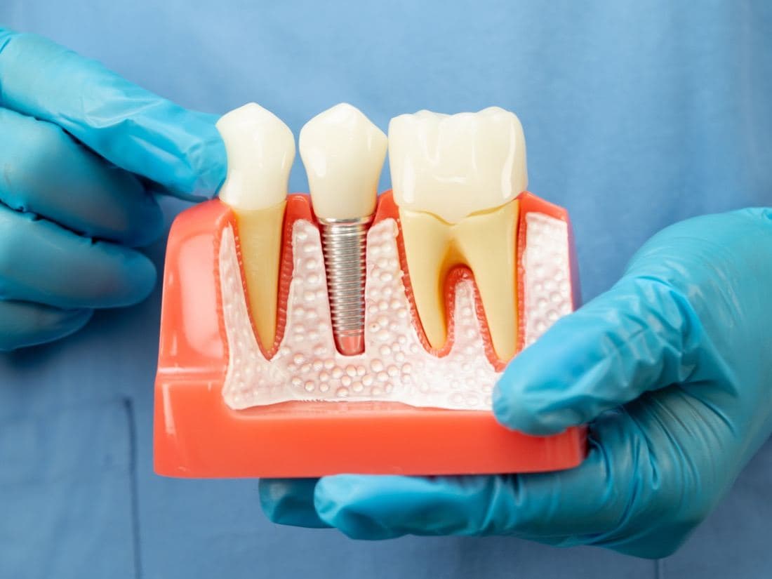 Trồng răng Implant