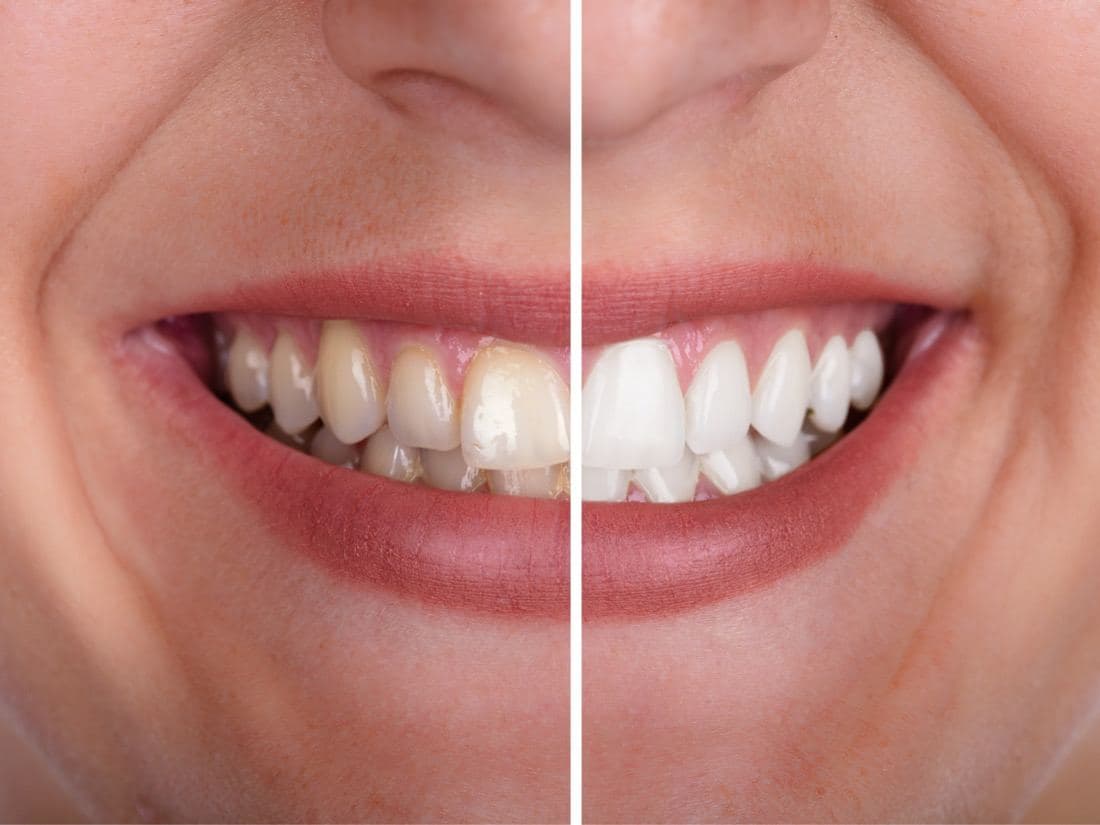 Thẩm mỹ Veneer răng sứ